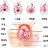 外阴白斑患者护理要注意哪些方面？