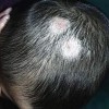 头癣患者早期的症状表现是什么