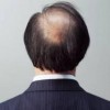 头癣病情加重的原因是什么
