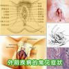 中医如何鉴别外阴白斑？