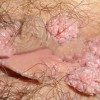 怎样去预防性病淋巴肉芽肿