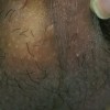 如何预防治疗混合性性病感染