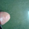 性病淋巴肉芽肿如何进行预防