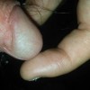 性病淋巴肉芽肿患者有哪些症状