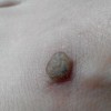 怎么预防寻常疣