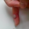 怎样预防寻常疣的出现