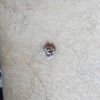 预防寻常疣的方法有哪些