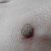日常预防寻常疣的方法