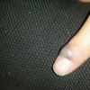 寻常疣患者注意事项