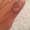 怎么做才能避免寻常疣传染发病
