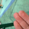 医院专家浅谈寻常疣