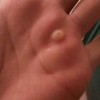 寻常疣的症状特点有哪些呢？