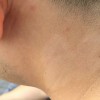 白癜风的预防措施