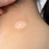 预防白癜风较有效的方法