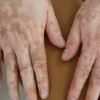女性得了泛发型白癜风的症状