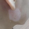 冬季白癜风症状是否会扩散