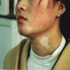 掌握哪些知识能判断白斑是不是白癜风