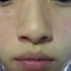 夏季如何预防皮肤过敏的发生