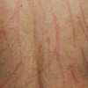 护理皮肤瘙痒正确方法