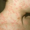 皮肤瘙痒症也需要做检查吗