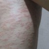 预防皮肤瘙痒症的措施都有哪些