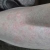 天气变冷该如何预防皮肤瘙痒