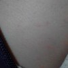 皮肤瘙痒都有哪些症状特点