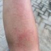 水源性皮肤瘙痒的症状