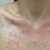 小心眼睛传染上传染性软疣