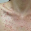 传染性软疣为什么会复发