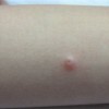 传染性软疣有什么表现特点
