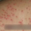 传染性软疣的病毒解释
