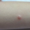传染性软疣症状表现特点