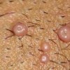 传染性软疣性接触传播很严重