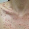 传染性软疣特点