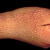 水瘊子临床表现是怎样的