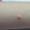 传染性软疣的临床表现类型介绍