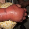丹毒患者需增加抵抗力