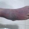 丹毒患者应该怎样的预防和治疗