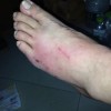 患了丹毒该如何治疗呢