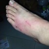 丹毒有什么治疗措施
