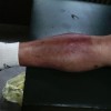 丹毒怎样治疗的方法介绍