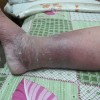 面部丹毒的治疗方法