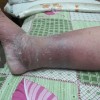 小儿丹毒患者发烧怎么办