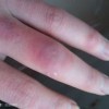 冻疮的预防方法介绍