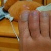 预防手生冻疮