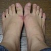 疏通血脉是防治冻疮的关键