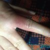 冬季要如何预防冻疮呢