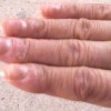 怎样做能预防冻疮