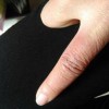 冬季保健怎么防冻疮